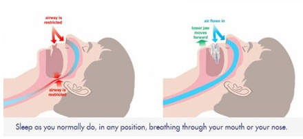 Dispositivo de Avance Mandibular DAM ® - Instituto Asturiano de